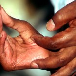 Mhoje_leprosy_photo_jpg
