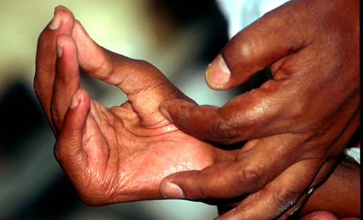 Mhoje_leprosy_photo_jpg