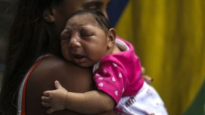 Mhoje_microcephalybaby_photo_jpg