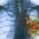 An X-ray of the chest of a man with tuberculosis. The areas infected with TB bacteria are colored red.