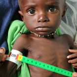 malnutrition