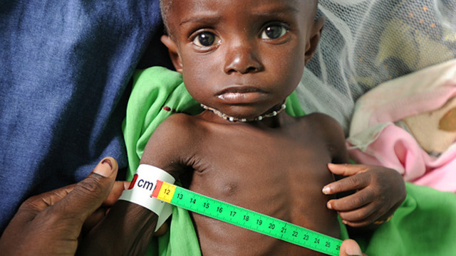 malnutrition