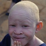 albino