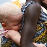 albino.baby1