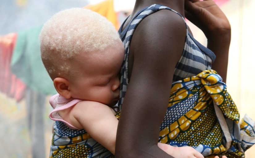 albino.baby1