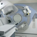 radiotherapy