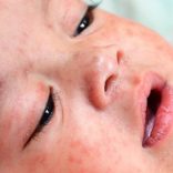_95354802_c0266147-measles-spl