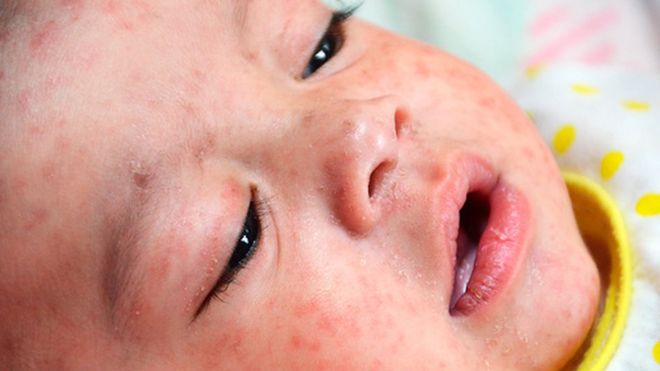 _95354802_c0266147-measles-spl