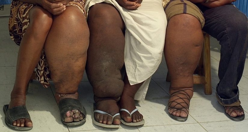 Elephantiasis