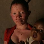 Albinism.mozambique.hrw_