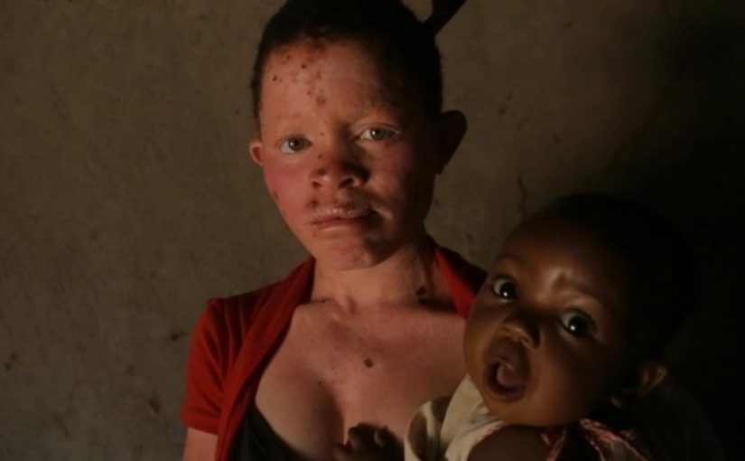 Albinism.mozambique.hrw_