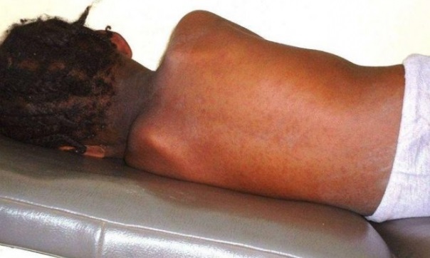 Measles.rm_