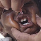 Misau-polio-466-1536x864