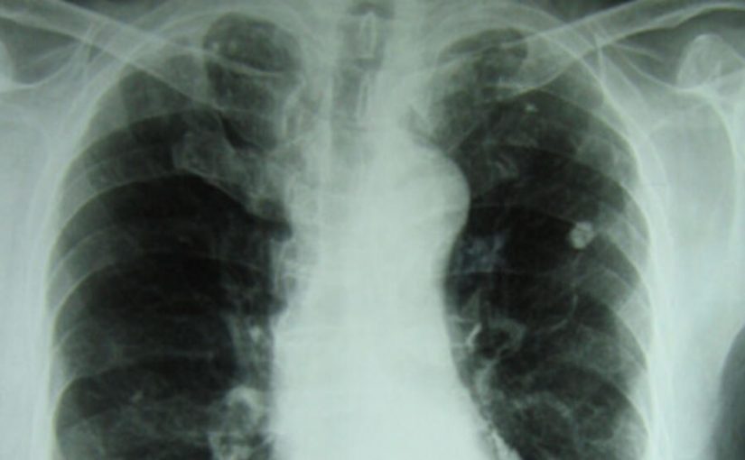Tuberculose