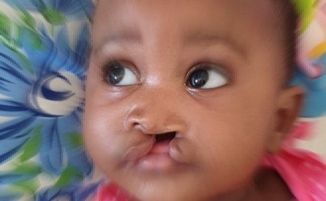 Filecleftlip.file_
